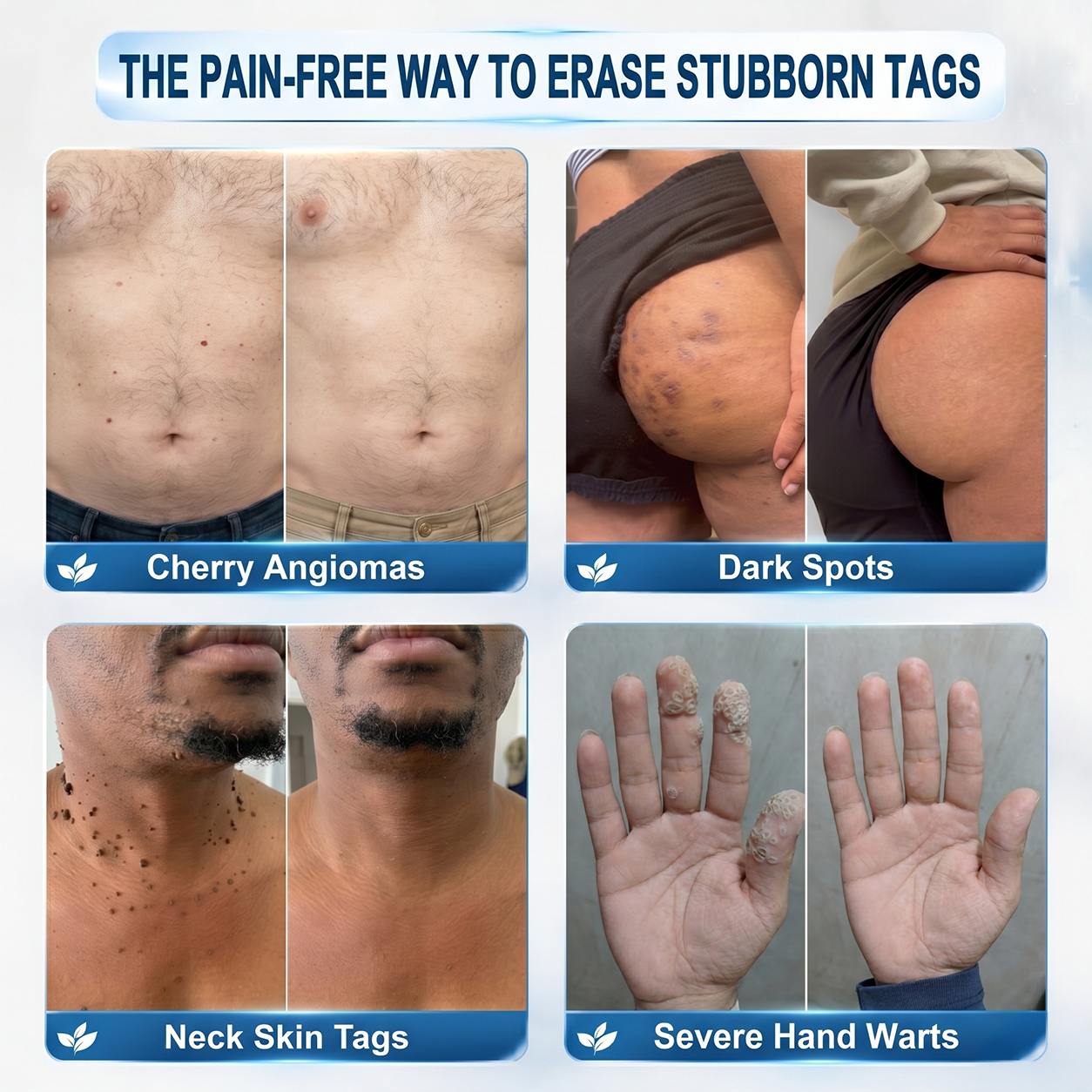Natravor® 7-Day Tag & Spot Eraser | At-Home Skin Tag & Spot Care Beauty Device