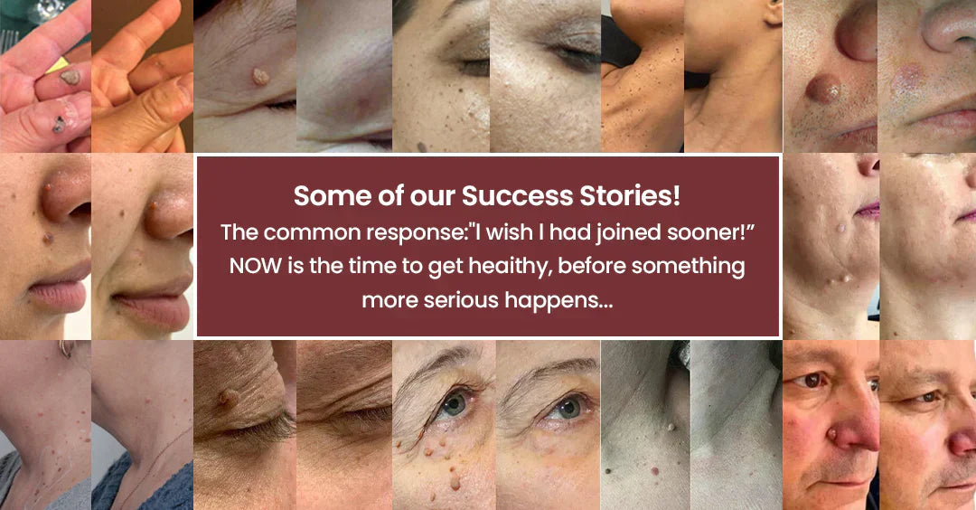 Before and after skin care results using 2-in-1 hydrocolloid microneedle patches