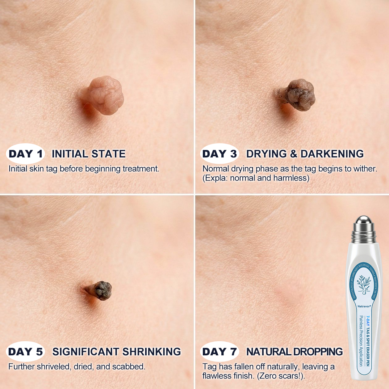 Natravor® 7-Day Tag & Spot Eraser | At-Home Skin Tag & Spot Care Beauty Device