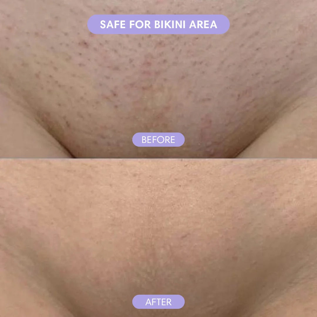 Wholly Bare - Hair Removal Pain-Free Hair Removal Mousse 50%OFF LAST DAY